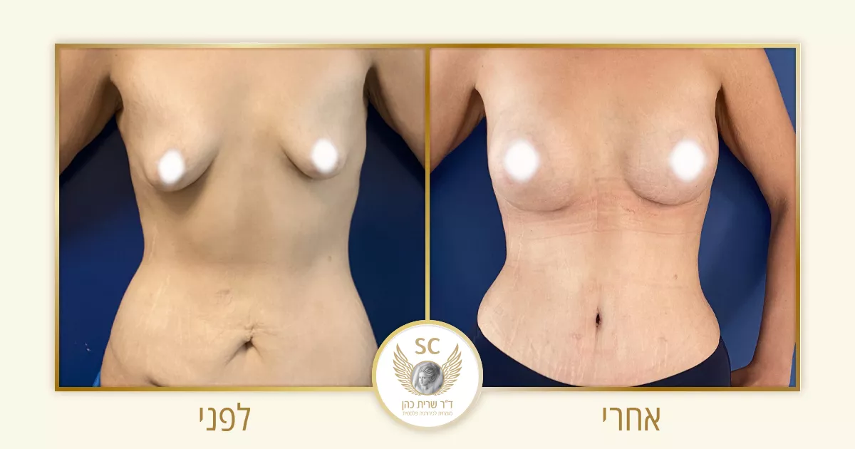 תמונת "לפני / אחרי" הרמת חזה