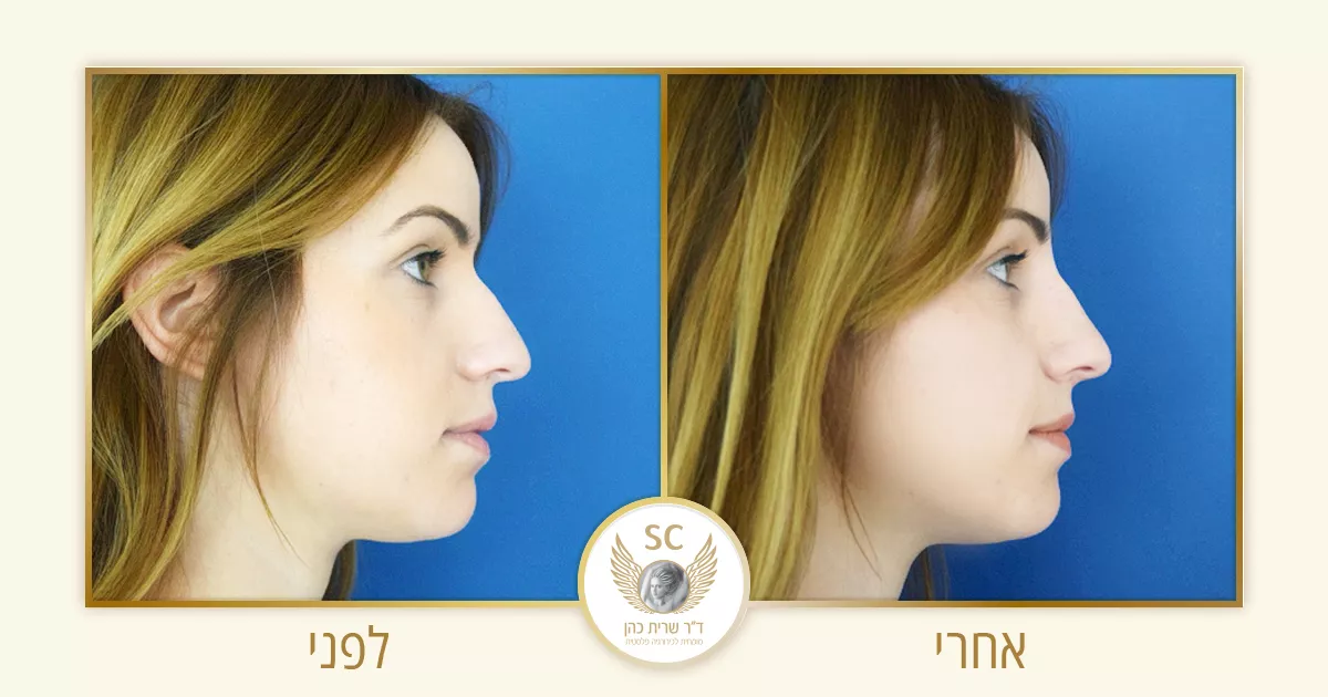 ד"ר שרית כהן - פיסול אף ללא ניתוח